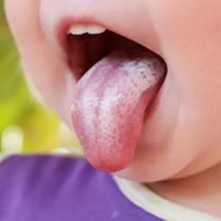 Candidal stomatitis (oral thrush)