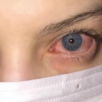 Conjunctivitis (bacterial, allergic and viral)